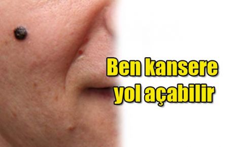 Ben kansere yol açabilir